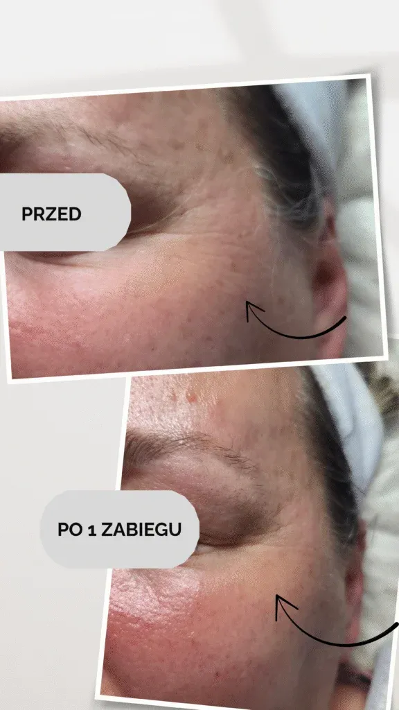 Poprawa cery i redukcja przebarwień w okolicy oka po 1 zabiegu — salon Me & Myself Wołomin